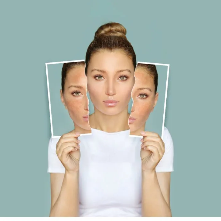 flacidez facial a los 40