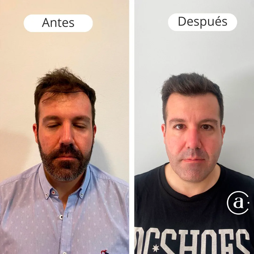 capilar-1