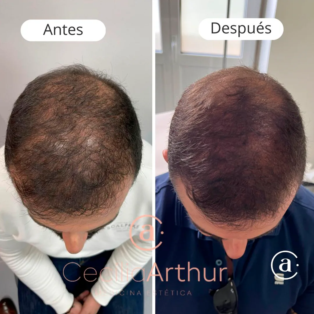 capilar-2