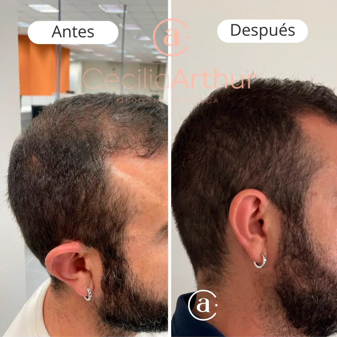 capilar-3