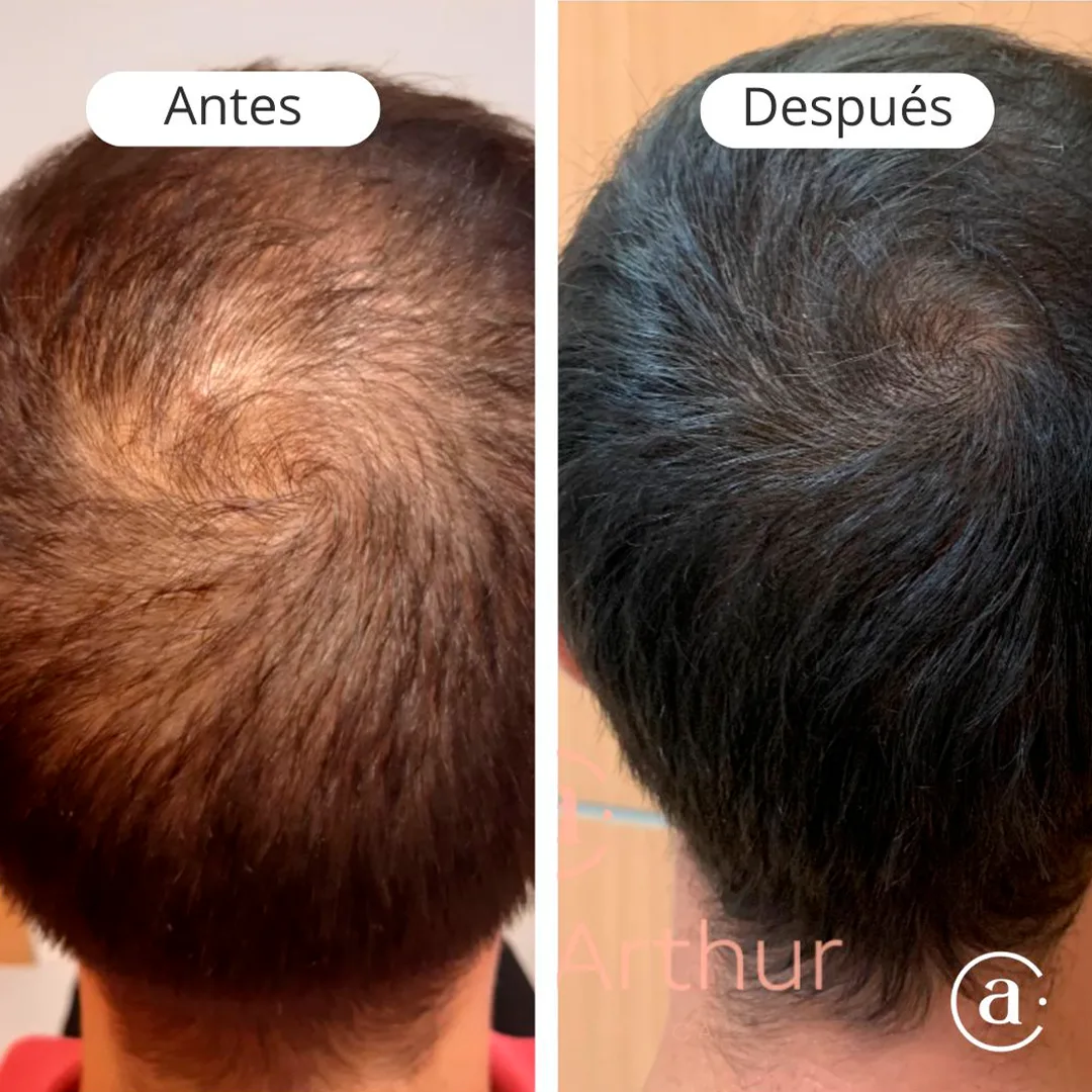 capilar-4