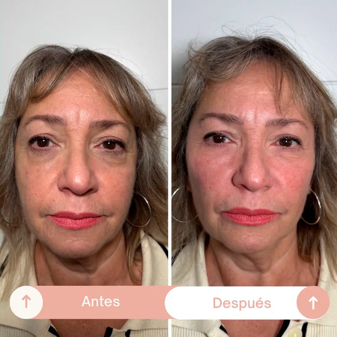 relleno de ojeras-1