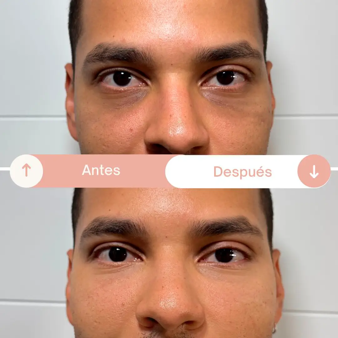 relleno de ojeras-2