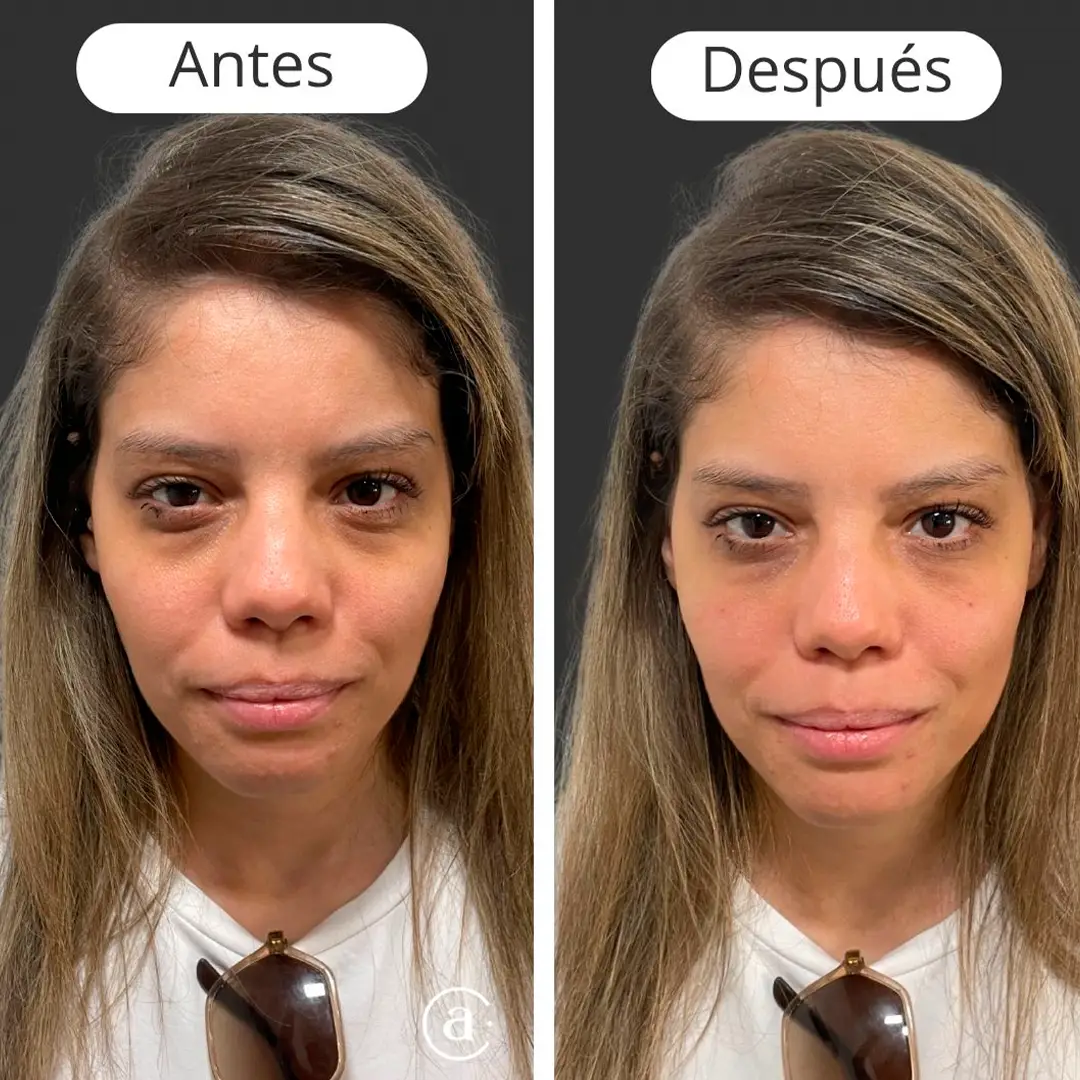 relleno de ojeras-3