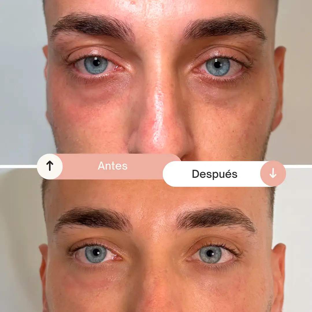 relleno de ojeras-4