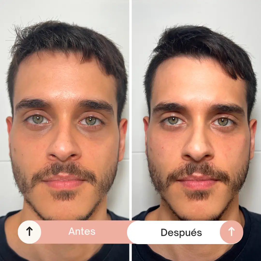 relleno de ojeras-5