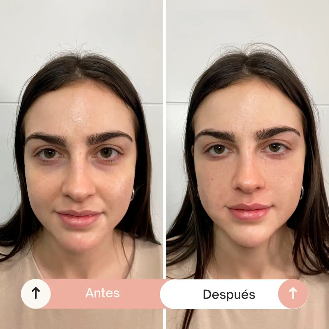 relleno de ojeras-6